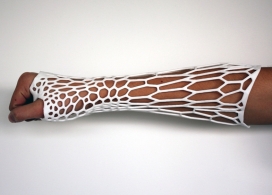 轻量级的3D打印肢体支架-可以取代传统笨重的石膏定型