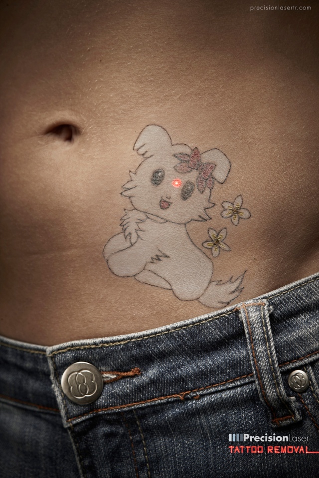 加拿大Precision Laser Tattoo Removal精密激光去除纹身平面---酷图编号1