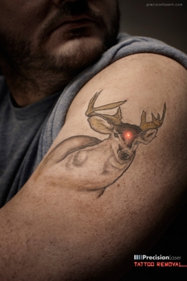 加拿大Precision Laser Tattoo Removal精密激光去除纹身平面