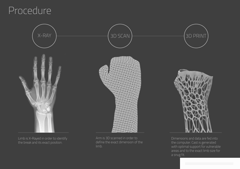 轻量级的3D打印肢体支架-可以取代传统笨重的石膏定型---酷图编号1059018
