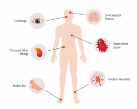 糖尿病并发症医学教育人体器官图
