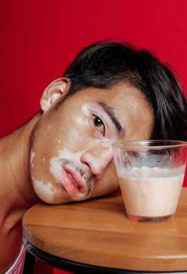 头靠在桌子上的白癜风男子