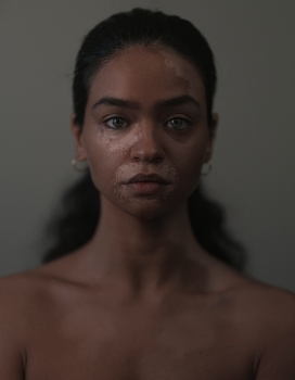 越南白癜风雀斑妇女图