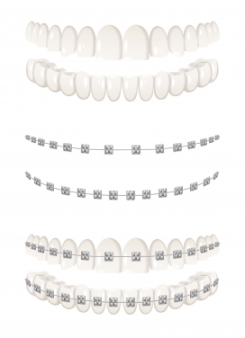 洁白的牙套牙齿假牙元素下载