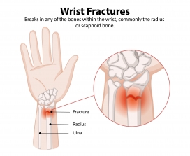 手腕骨折医学图