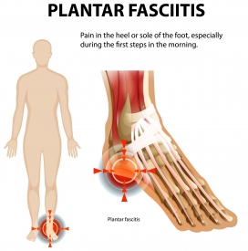卡通足底筋膜炎足痛素材