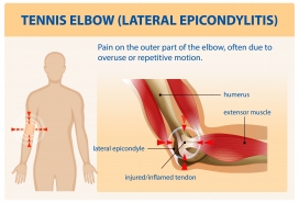 卡通网球肘的病因医学图