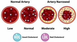 卡通胆固醇水平动脉图示