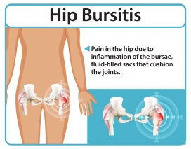 卡通髋关节滑囊炎素材
