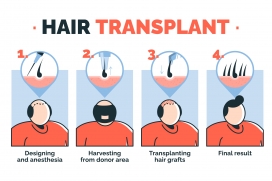 卡通四款毛发移植插图素材