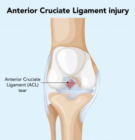 卡通前交叉韧带损伤素材